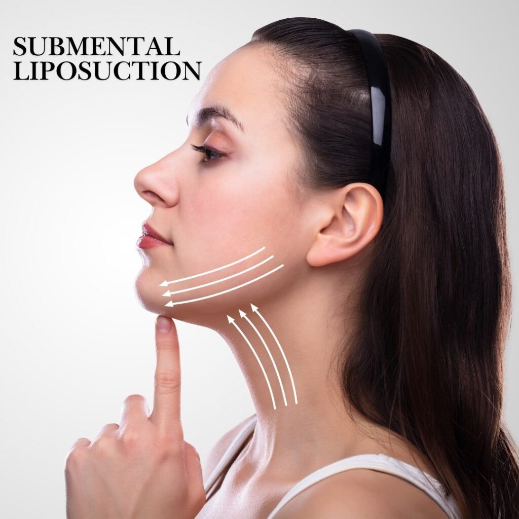 Submental Liposuction: Enhancing Your Profile from Every Angle